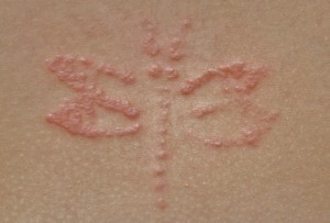 alergijski kontaktni dermatitis tetovaza