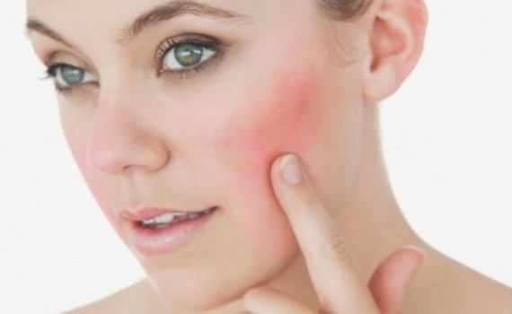 rosacea