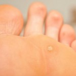 wart-on-foot-causes-treatment_2