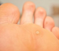 wart-on-foot-causes-treatment_2